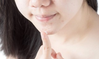 简单实用的祛痘小窍门 祛痘小妙招简单实用的方法